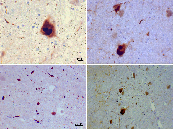 Demencia con cuerpos de Lewy - microscopio - NeuroClass