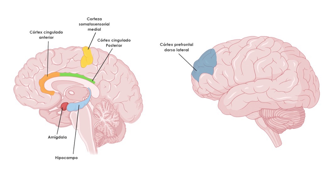 Cerebro fibromialgia NeuroClass