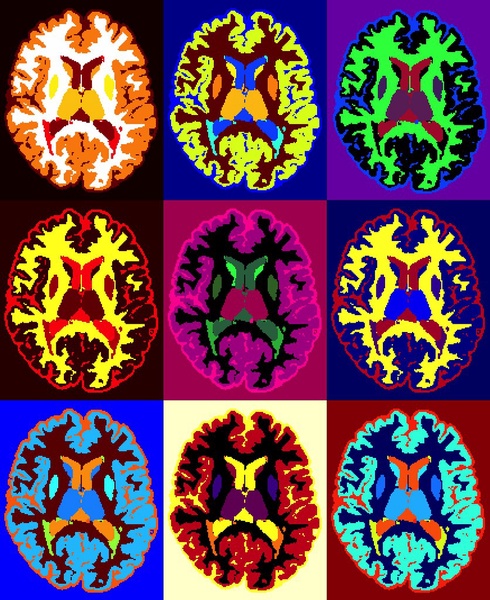 Cerebro - esclerosis múltiple - NeuroClass
