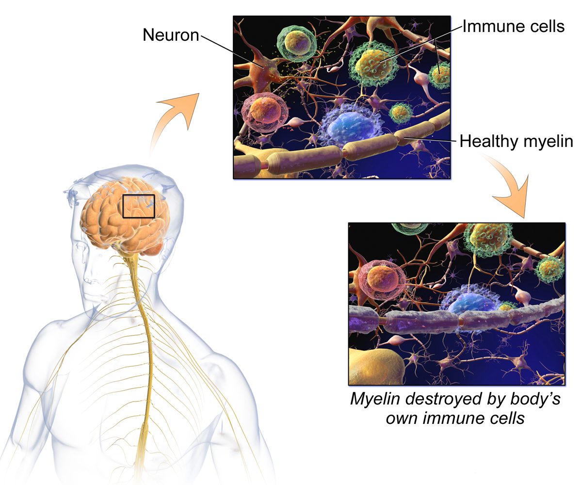 Esclerosis Múltiple: Afectación En El Sistema Nervioso Central - NeuroClass