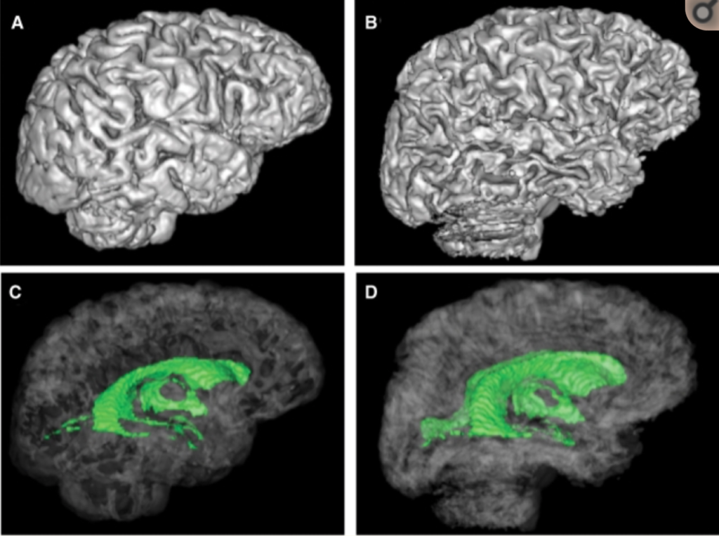 Síndrome Wernicke Korsakoff Causas Y Efectos Neuroclass 5456