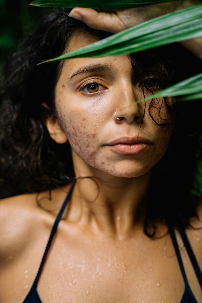 acné y salud mental, acné depresión y ansiedad