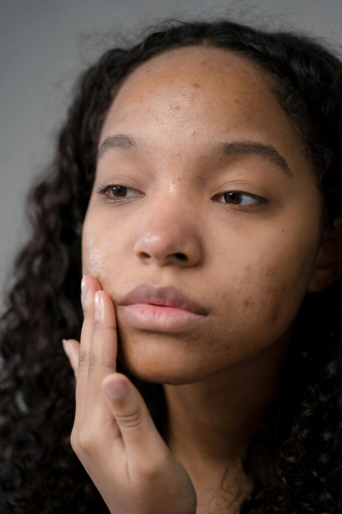 acné y salud mental, acné depresión y ansiedad