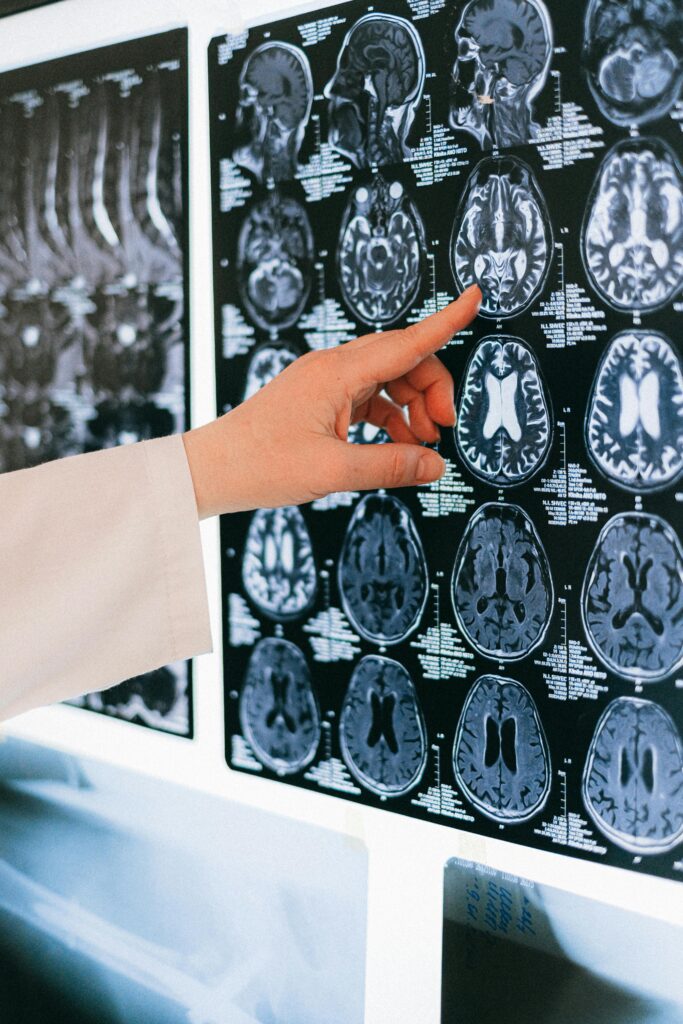 Lesión cerebral, suicidio, ideación suicida